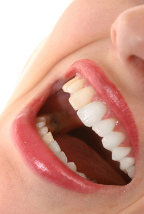 Teeth Whitening Bristol - High Street Dental Clinic