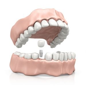 Bristol Dental Implants - Tooth Implant dentist - High Street Dental Clinic